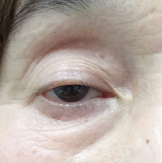 腱膜性眼瞼下垂